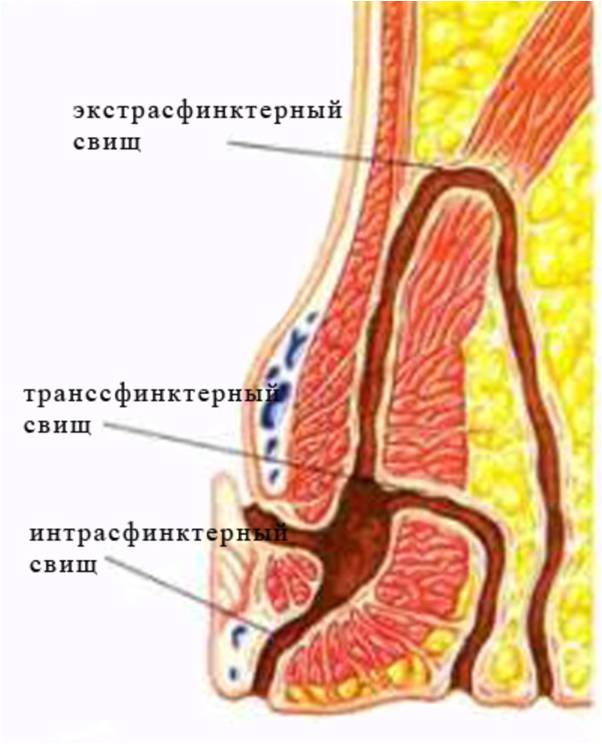 paraproktit2.jpg